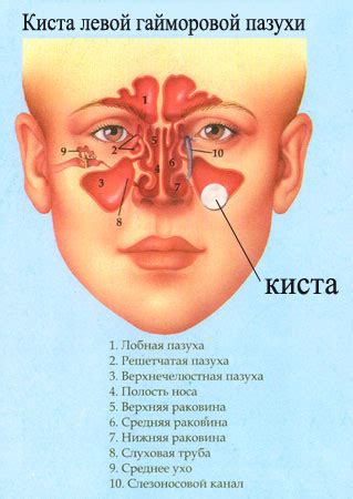 Удаление кисты в пазухе: методика, преимущества, последствия