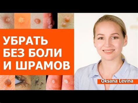 Удаление папилломы без боли и оставления следов