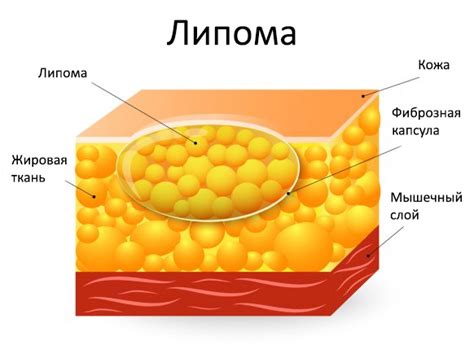 Узнайте, что такое липома и как она возникает