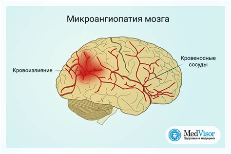 Узнайте о МР-признаках микроангиопатии головного мозга: