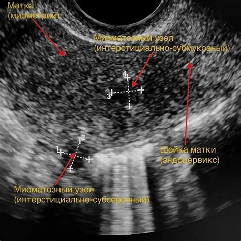 Ультразвуковая диагностика миомы