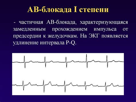 Ускоренное ав проведение у детей