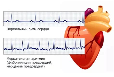 Ускоренный предсердный ритм - основные признаки