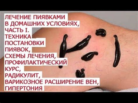 Уход за пиявками после использования в домашних условиях