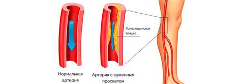 Ухудшение кровообращения в ногах