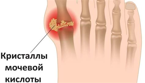 Факторы, влияющие на образование мозоли на мизинце ноги