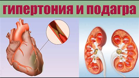 Факторы, влияющие на уровень мочевой кислоты