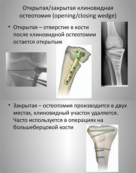 Феморальная остеотомия