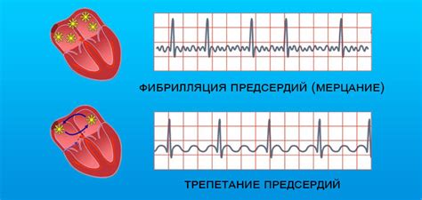 Фибрилляция и трепетание: основные различия