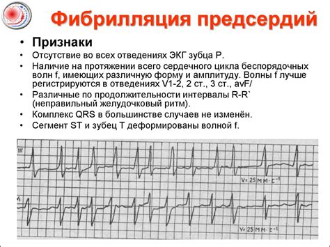 Фибрилляция предсердий и трепетание предсердий: причины, симптомы, диагностика и лечение