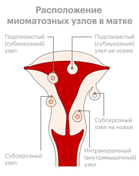 Фиброиды и миома матки