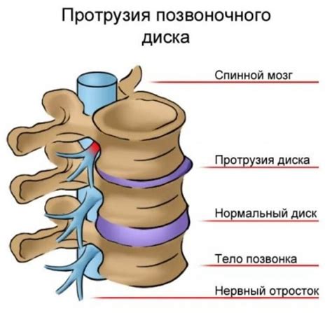 Физиотерапия при циркулярном пролабировании межпозвонковых дисков