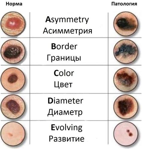 Физические признаки родинки на пальце