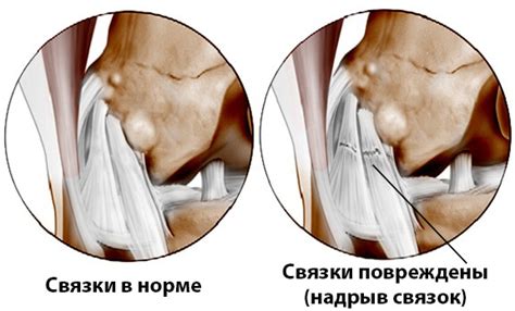 Функции медиальной боковой связки коленного сустава