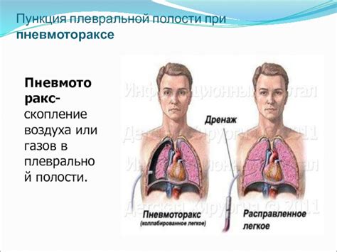 Функции плевральной полости и ее местоположение