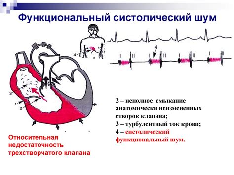 Функциональный систолический шум у ребенка: причины, симптомы, диагностика и лечение