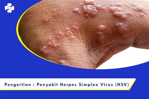 Характеристика и симптомы herpes simplex virus 1