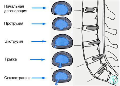 Хирургическое вмешательство при циркулярном пролабировании межпозвонковых дисков