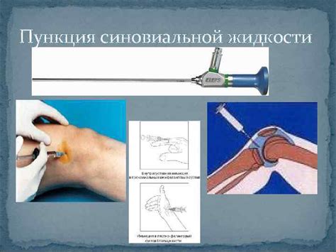 Цитоз в синовиальной жидкости повышенный