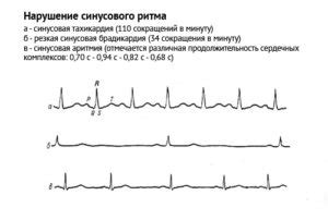 ЧСС - ритм сердечной деятельности