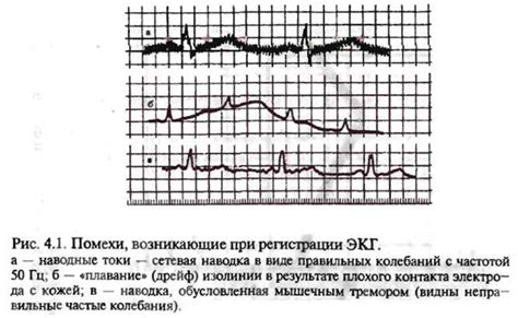 Часто возникающие проблемы при проведении ЭКГ и их решение