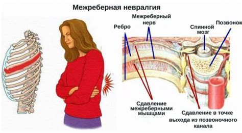 Частые симптомы межреберной дистонии