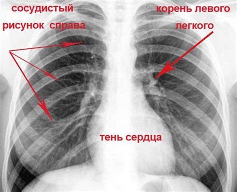 Что делать при подозрении на перелом ребра