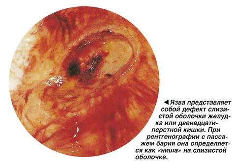 Что представляет собой язва на плаценте?