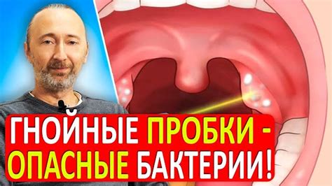 Что такое белые комочки в горле и что их вызывает