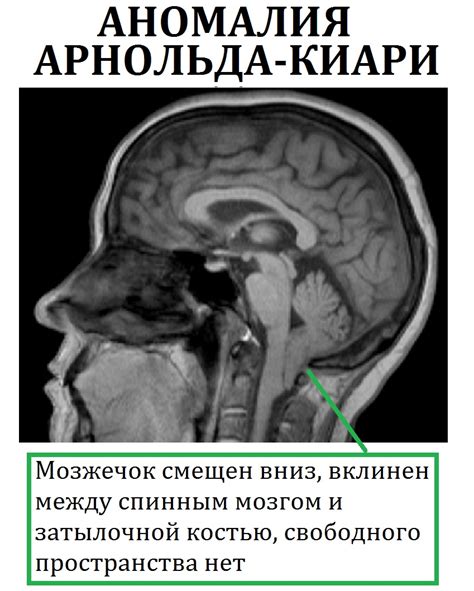 Что такое гипотрофические изменения головного мозга