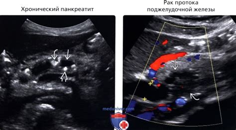 Что такое дилатация затылочных рогов?