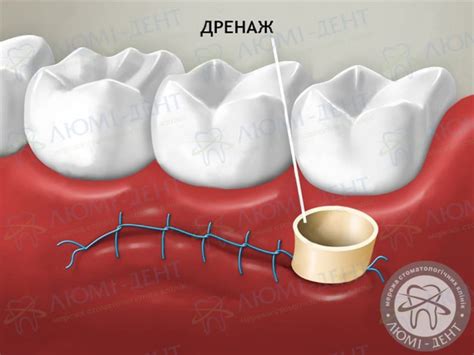Что такое дренаж в десне