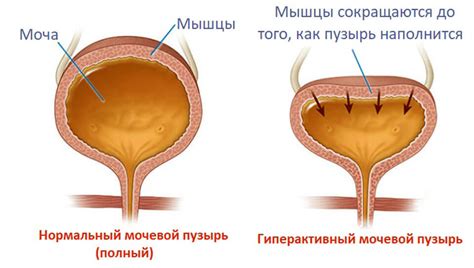 Что такое загиб мочевого пузыря?