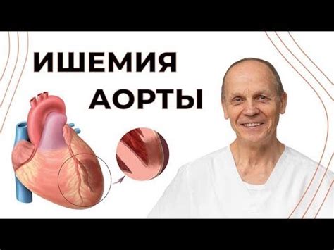 Что такое ишемия аорты