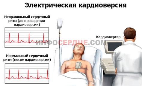 Что такое кардиоверсия и как проходит процедура