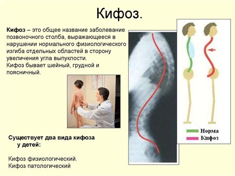 Что такое кифотическая осанка?