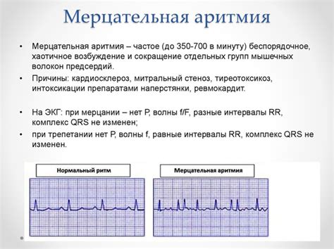 Что такое мерцательная аритмия?