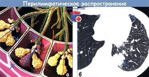 Что такое перилимфатические очаги