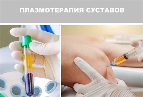 Что такое плазмолифтинг суставов и для чего он используется