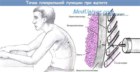 Что такое пункция и зачем она проводится