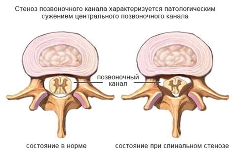 Что такое стеноз?