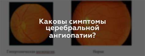 Что такое стриарная ангиопатия