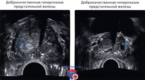 Что такое узел в предстательной железе?