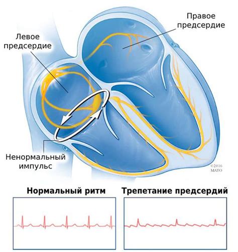 Что такое фибрилляция предсердий и трепетание предсердий?