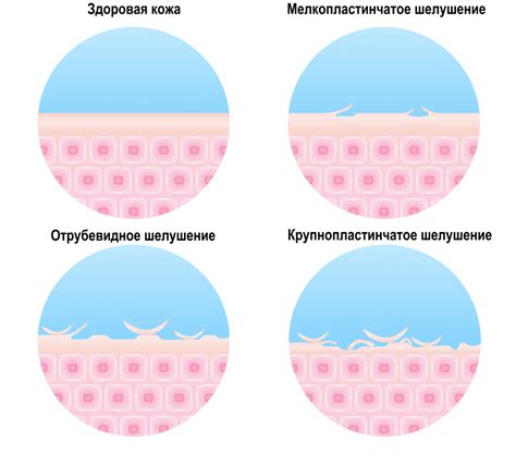 Что такое шелушение кожи