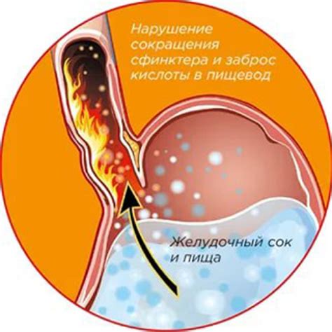 Что такое эрозия пищевода и как она возникает