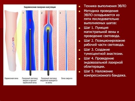 Шаг 2: Удаление кишечной вены