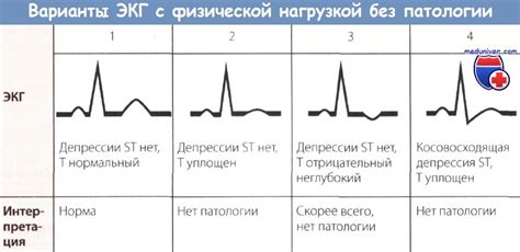 ЭКГ после задержания дыхания: особенности регистрации