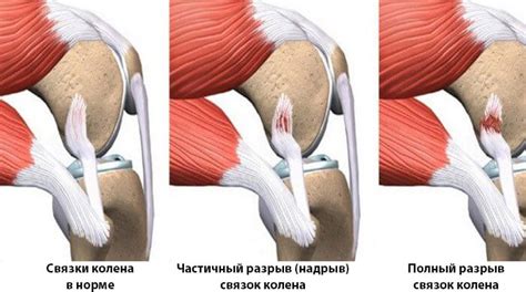 Экстренные меры для лечения поврежденной связки на бедре