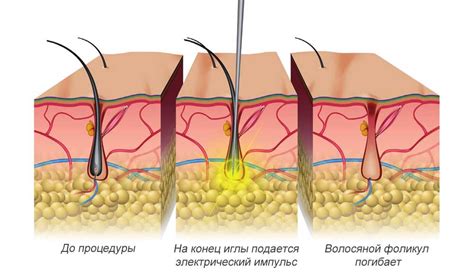 Электроэпиляция